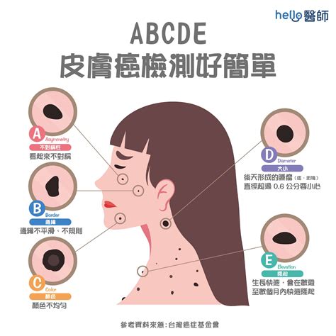 臉上的痣|痣變大、痣多或長毛會變皮膚癌？認識痣的形成與原因